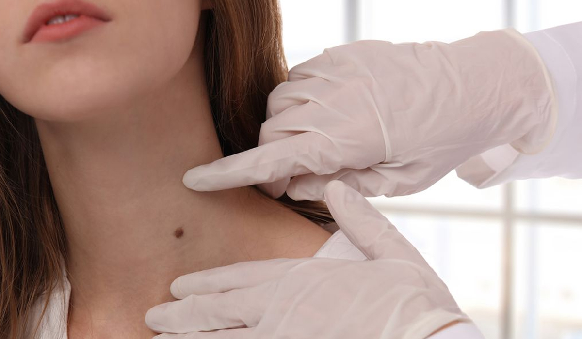 7 easy and homemade ways to remove skin tags without going to a doctor
